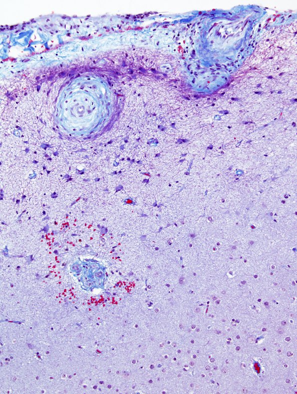 5E2 Amyloid B-related angiitis (ABRA) (Case 5) Trichrome 3