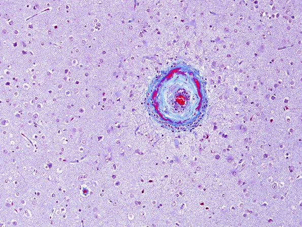 5E3 Amyloid B-related angiitis (ABRA) (Case 5) Trichrome 4