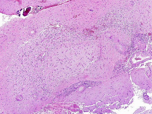 6A1 Congophilic Angiopathy & ABRA (Case 6) H&E 8