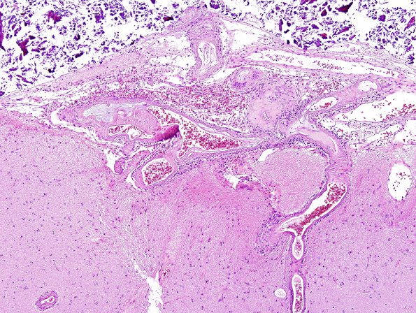 6A2 Congophilic Angiopathy & ABRA (Case 6) H&E 12