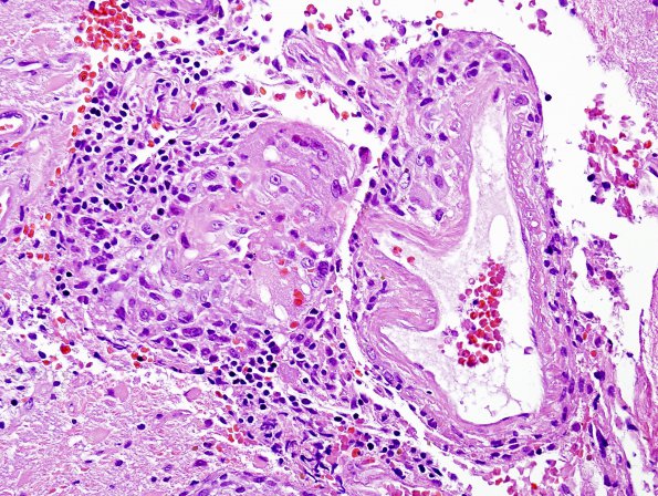 6A3 Congophilic Angiopathy & ABRA (Case 6) H&E 5