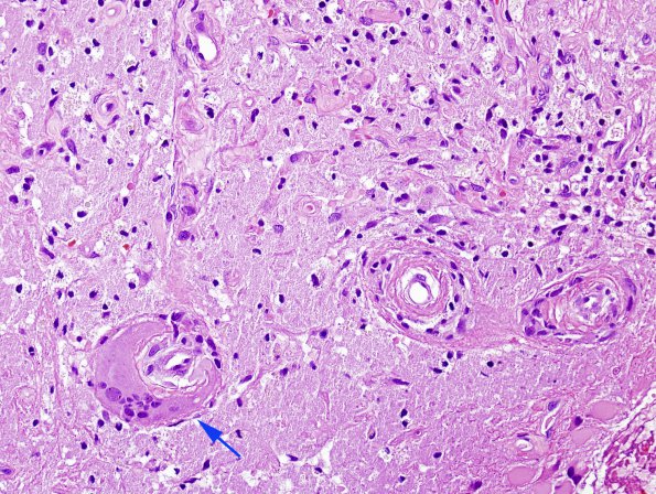 6A4 Congophilic Angiopathy & ABRA (Case 6) H&E 7 copy