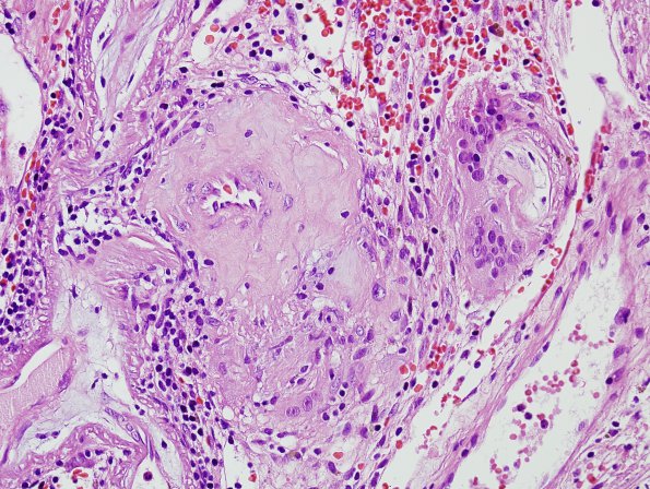 6A5 Congophilic Angiopathy & ABRA (Case 6) H&E 9