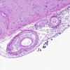 6A6 Congophilic Angiopathy & ABRA (Case 6) H&E 10