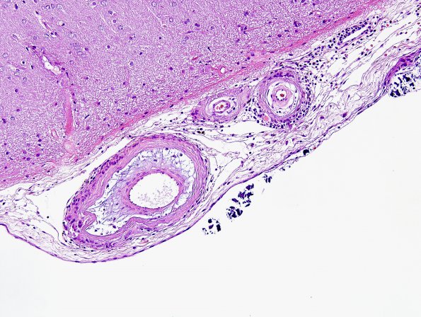 6A6 Congophilic Angiopathy & ABRA (Case 6) H&E 10