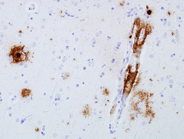 6B2 Congophilic Angiopathy & ABRA (Case 6) Bamyloid 6