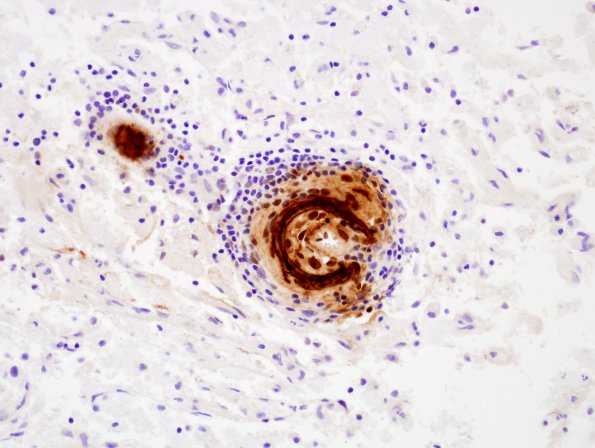 6B3 Congophilic Angiopathy & ABRA (Case 6) Bamyloid 2