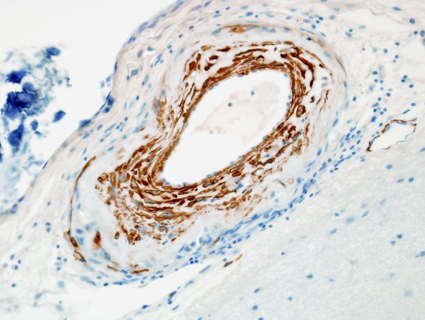 6C2 Congophilic Angiopathy & ABRA (Case 6) SMA 3