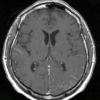 7A1 Amyloid-Related Angiitis (Case 7) T1 W 2 - Copy