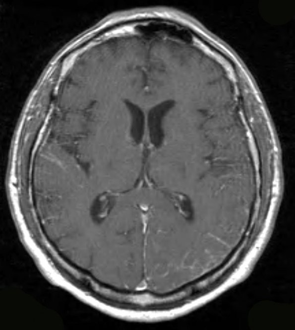 7A1 Amyloid-Related Angiitis (Case 7) T1 W 2 - Copy