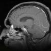 7A2 Amyloid-Related Angiitis (Case 7) T1 W 4 - Copy