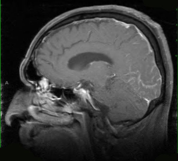 7A2 Amyloid-Related Angiitis (Case 7) T1 W 4 - Copy