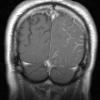 7A3 Amyloid-Related Angiitis (Case 7) T1 W 5 - Copy