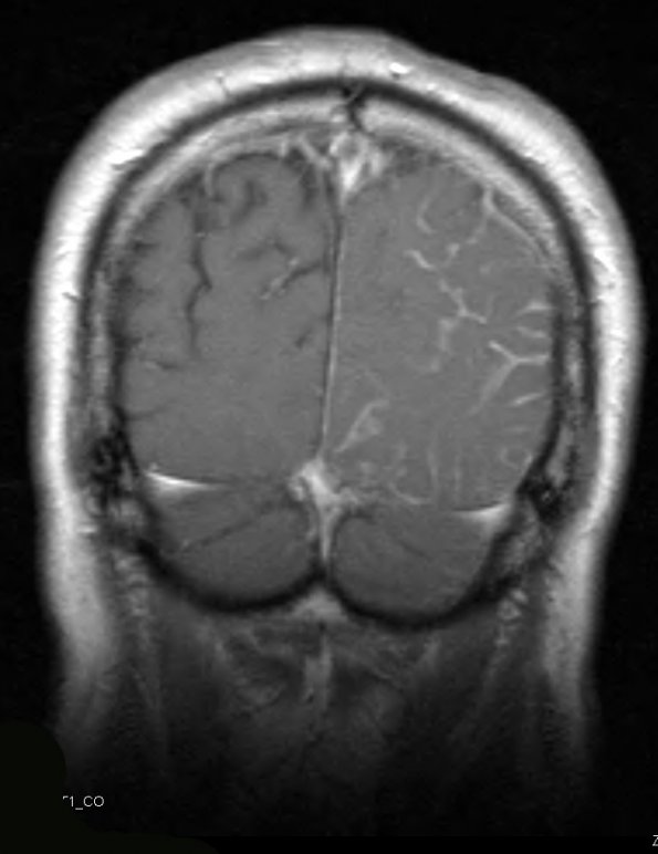 7A3 Amyloid-Related Angiitis (Case 7) T1 W 5 - Copy