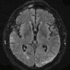 7A4 Amyloid-Related Angiitis (Case 7) T2 1 - Copy