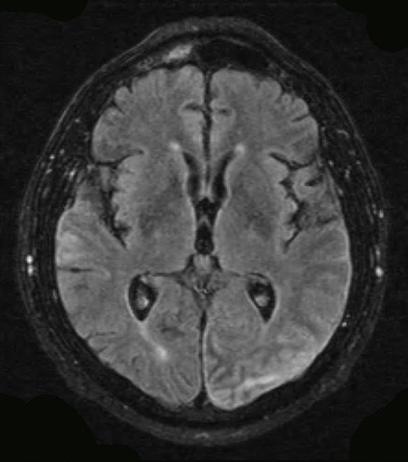 7A4 Amyloid-Related Angiitis (Case 7) T2 1 - Copy