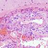 7B1 Amyloid-Related Angiitis (Case 7) H&E 1