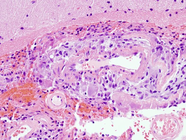 7B1 Amyloid-Related Angiitis (Case 7) H&E 1