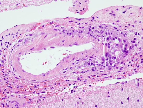 7B2 Amyloid-Related Angiitis (Case 7) H&E 3