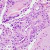 7B3 Amyloid-Related Angiitis (Case 7) H&E 5