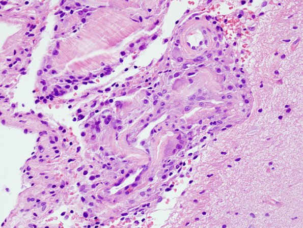 7B3 Amyloid-Related Angiitis (Case 7) H&E 5