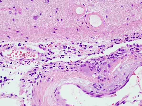 7B4 Amyloid-Related Angiitis (Case 7) H&E 6