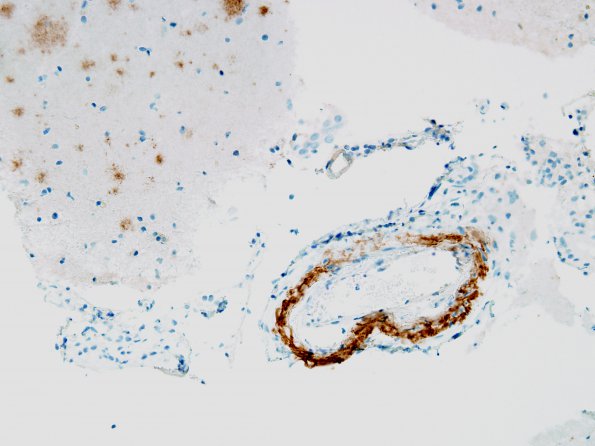 7C Amyloid-Related Angiitis (Case 7) BAmyloid  2 (2) - Copy