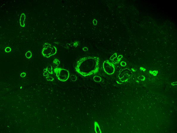 7D Amyloid-Related Angiitis (Case 7) 1097