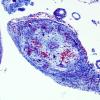 7E1 Amyloid-Related Angiitis (Case 7) Trichrome