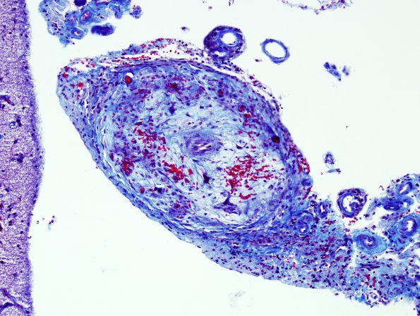 7E1 Amyloid-Related Angiitis (Case 7) Trichrome