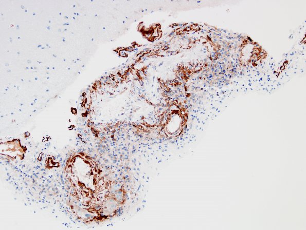 7E2 Amyloid-Related Angiitis (Case 7) SMA 1