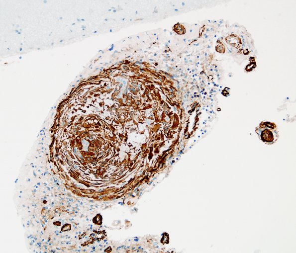 7E3 Amyloid-Related Angiitis (Case 7) SMA 2