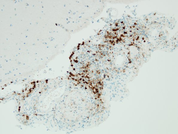 7F Amyloid-Related Angiitis (Case 7) CD3