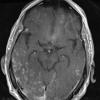 8A1 Granulomatous Angiitis (Case 8) T1 W 2 - Copy