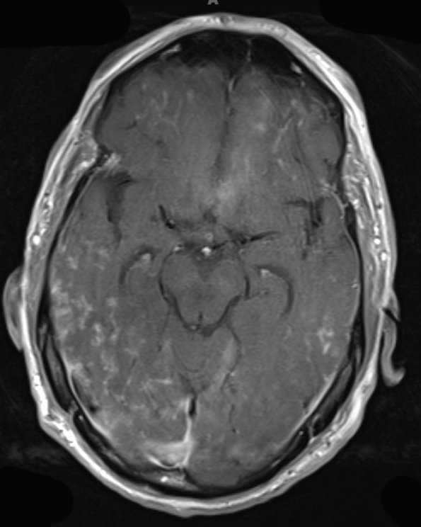 8A1 Granulomatous Angiitis (Case 8) T1 W 2 - Copy