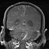 8A2 Granulomatous Angiitis (Case 8) T1 W 1 - Copy