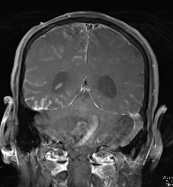 8A2 Granulomatous Angiitis (Case 8) T1 W 1 - Copy