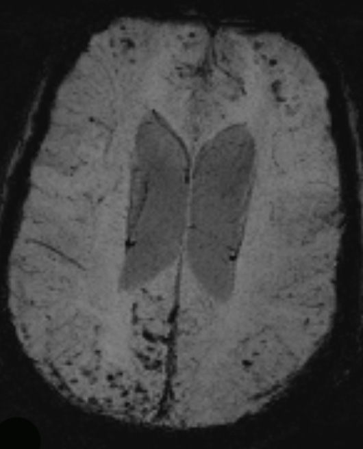 8A3 Granulomatous Angiitis (Case 8) MIP Images (SW) 1 - Copy