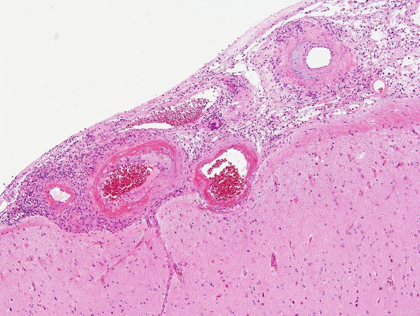 8B1 Angiitis, granulomatous vs ABRA (Case 8) H&E 7