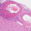 8B2 Angiitis, granulomatous vs ABRA (Case 8) H&E 2