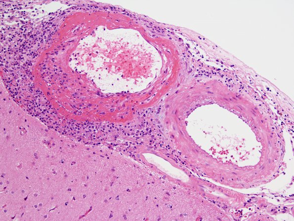 8B2 Angiitis, granulomatous vs ABRA (Case 8) H&E 2