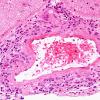 8B3 Angiitis, granulomatous vs ABRA (Case 8) H&E 1