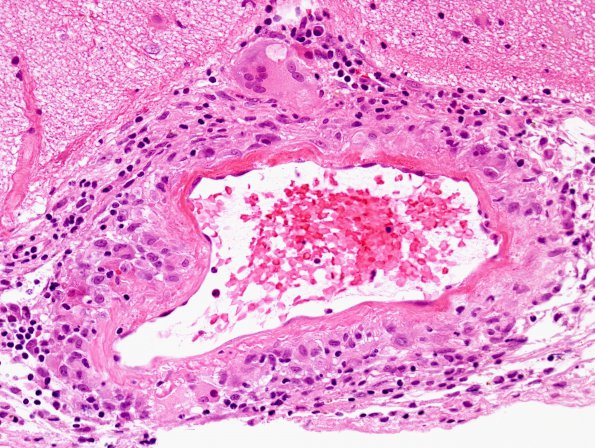 8B3 Angiitis, granulomatous vs ABRA (Case 8) H&E 1