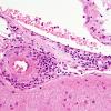 8B4 Angiitis, granulomatous vs ABRA (Case 8) H&E 4