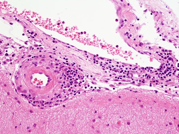 8B4 Angiitis, granulomatous vs ABRA (Case 8) H&E 4