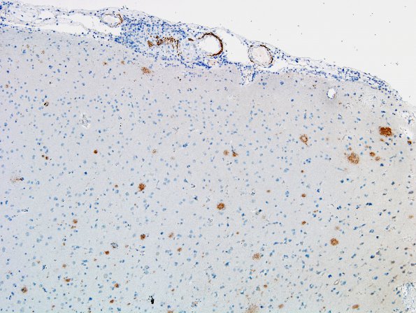 8C1 Angiitis, granulomatous vs ABRA (Case 8) BAmyloid 2A