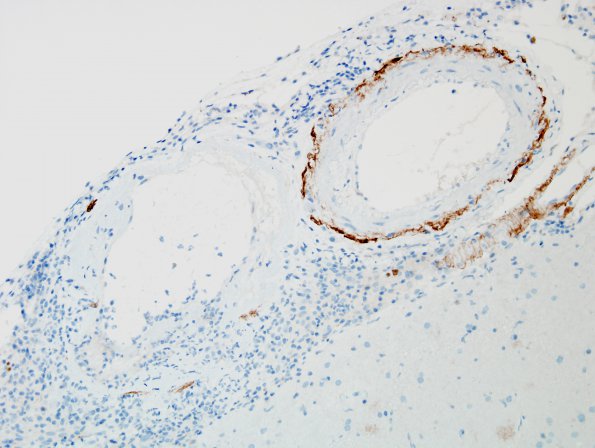 8C2 Angiitis, granulomatous vs ABRA (Case 8) BAmyloid 4