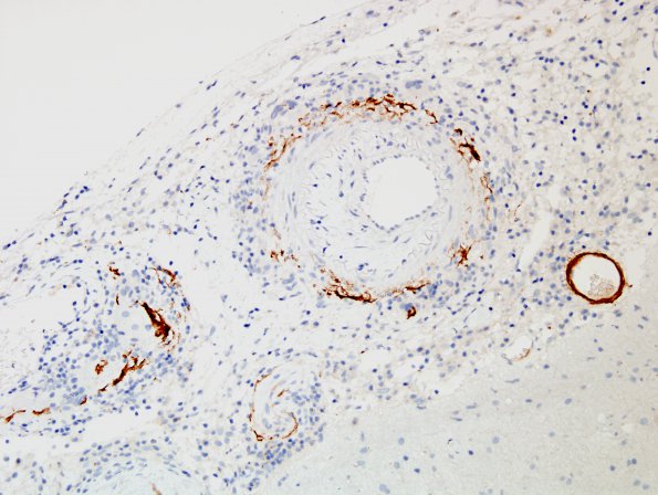 8C3 Angiitis, granulomatous vs ABRA (Case 8) BAmyloid 5