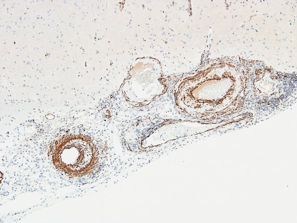 8E1 Angiitis, granulomatous vs ABRA (Case 8) SMA 5