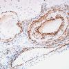 8E2 Angiitis, granulomatous vs ABRA (Case 8) SMA 7